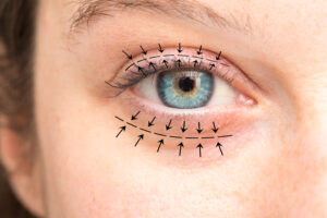 Blepharoplasty