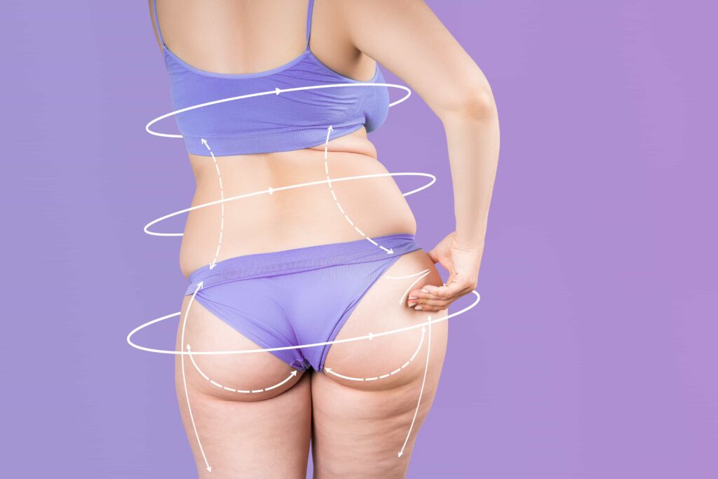 Body Contouring
