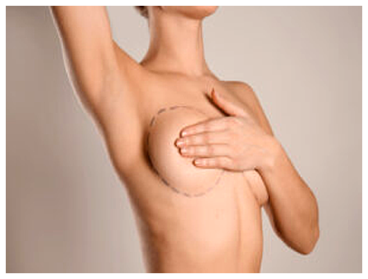 Breast Augmentation