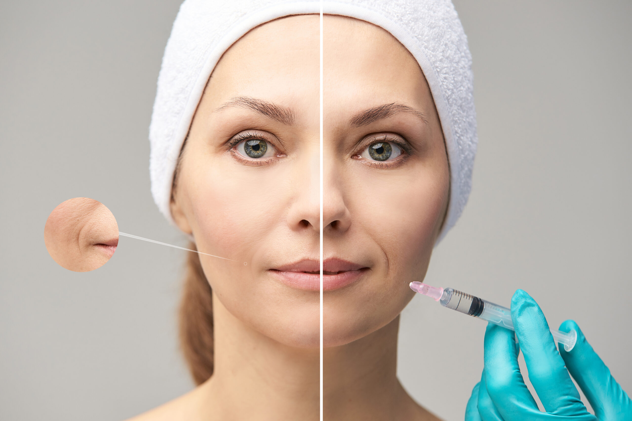 Dermal Fillers