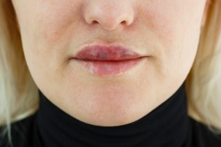 woman asymmetric lips as a result after lip augmentation with hyaluronic acid filler entered incorrectly, bad result, cosmetologist's mistake, contour lip plastic surgery.