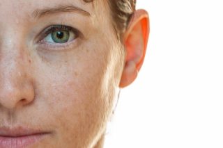 sun spots treatments