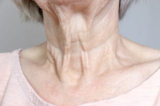 A flabby wrinkled excess skin on the neck of a senior woman close up.