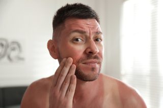 Man with sunburn on skin at home