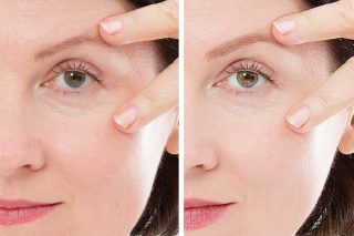 Belotero filler under eye