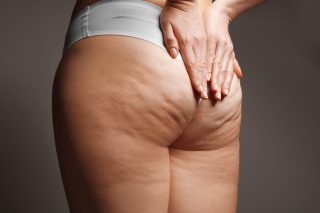 Cellulite and treatments for it.
