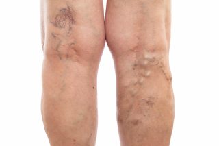 varicose veins-compressed