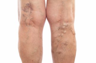 Varicose veins treatment